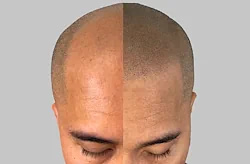 Scalp micropigmentation : everything to know