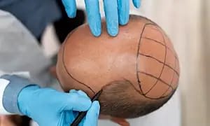 Hair transplant: everything you need to know.